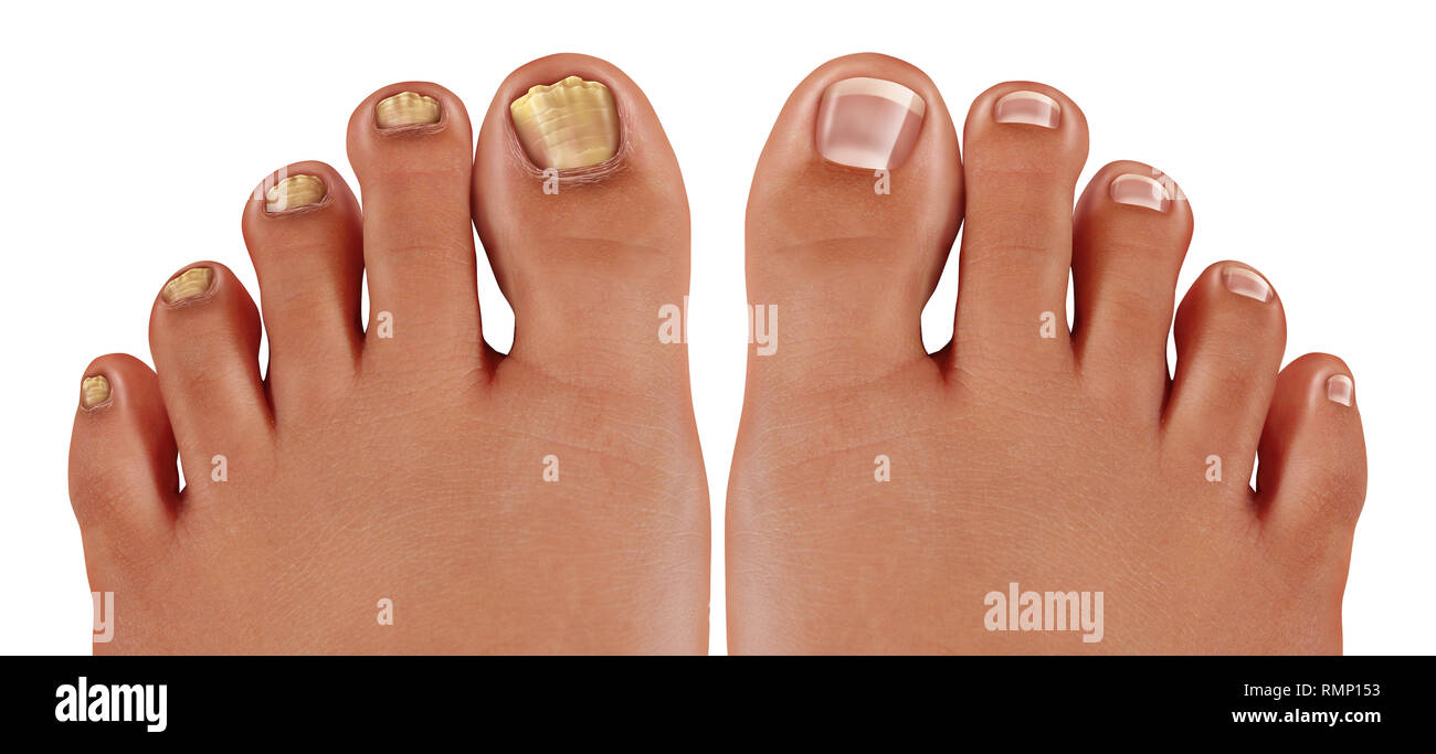 Onychomykose und Pilzinfektionen nagelinfektion oder tinea unguium Als infizierten Fuß zehennagel oder Toe Nail mit beschädigten ungesunde und gesunde menschliche Anatomie. Stockfoto