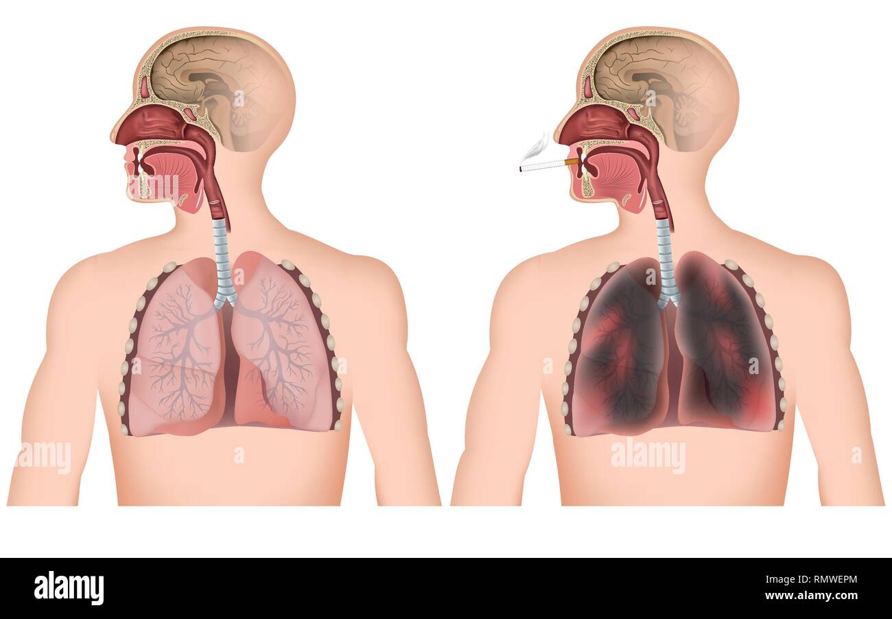 Rauchen Lungenkrebs medizinische Vector Illustration auf weißem  Hintergrund, Mann mit cigerette Stock-Vektorgrafik - Alamy