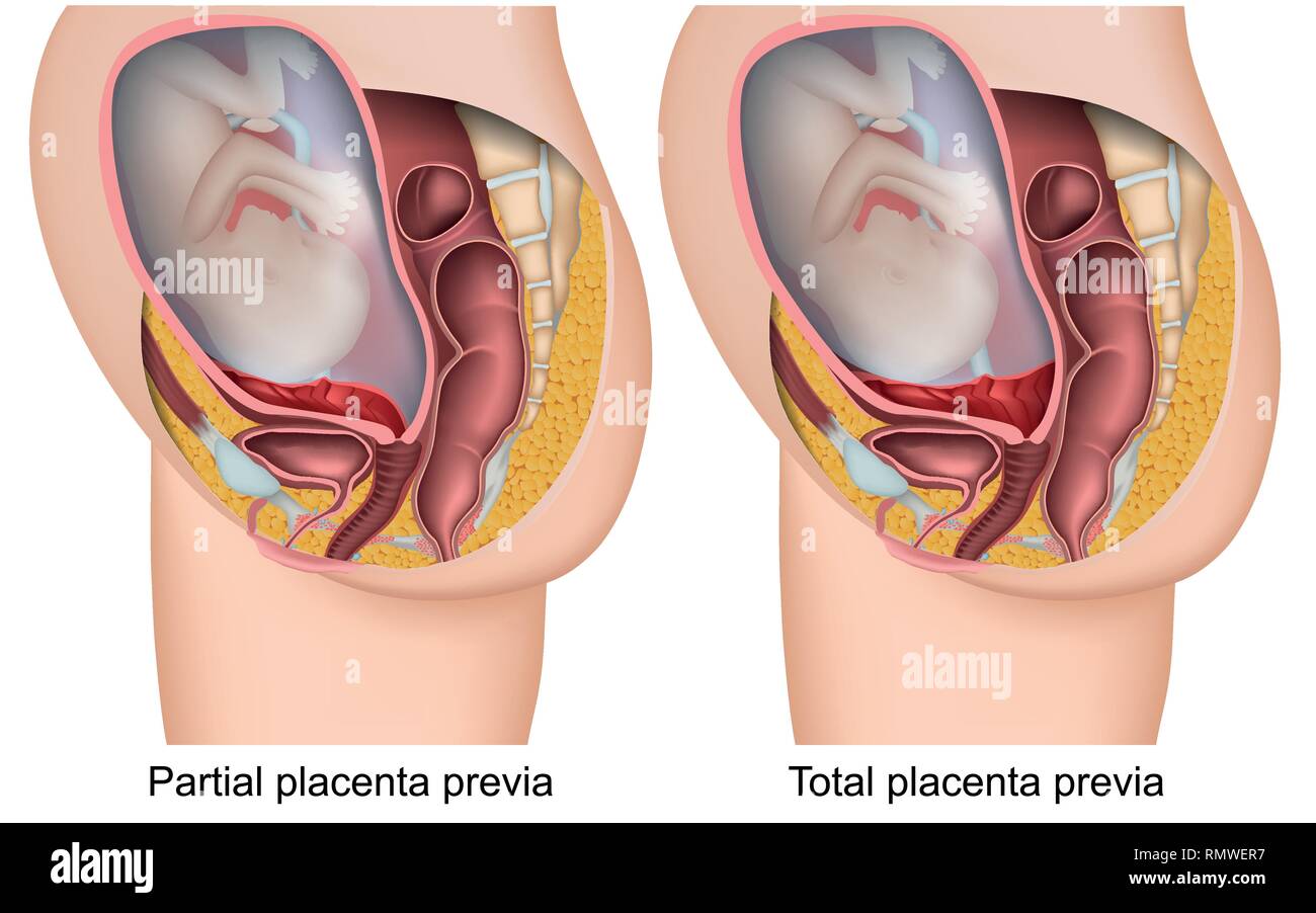 Plazenta brevia Schwangerschaft 3d Vektor Illustration auf weißem Hintergrund Stock Vektor