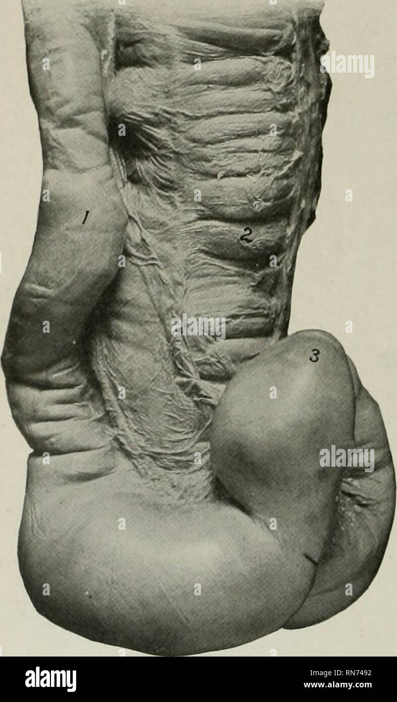 . Die Anatomie der Haustiere. Veterinär Anatomie. 428 VERDAUUNGSSYSTEM DES PFERDES haben einen Durchmesser von etwa 20 Zoll (50 cm). Dies wird durch eine trichterförmige terminal Kontraktion gelungen. Die rechten ventralen Teil des großen doppelpunkt ist auf den geringeren Krümmung der ctecum durch zwei Schichten des Bauchfells, die caeco-koliken Falten (Plica csecocolica). Die richtigen Teile von bauchfell auf beiden Seiten und auch durch areolar Tissue- und muskulösen Fasern vereint sind, die Oberfläche der Kontakt über vier oder fünf Zoll (Ca. 10 bis 12 cm) breit; der linke Teile sind miteinander verbunden Stockfoto