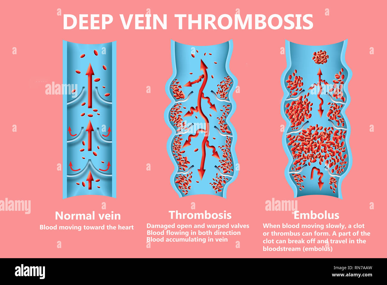 Thrombose. Von den normalen Blutfluss zu Blutgerinnsel Stockfoto