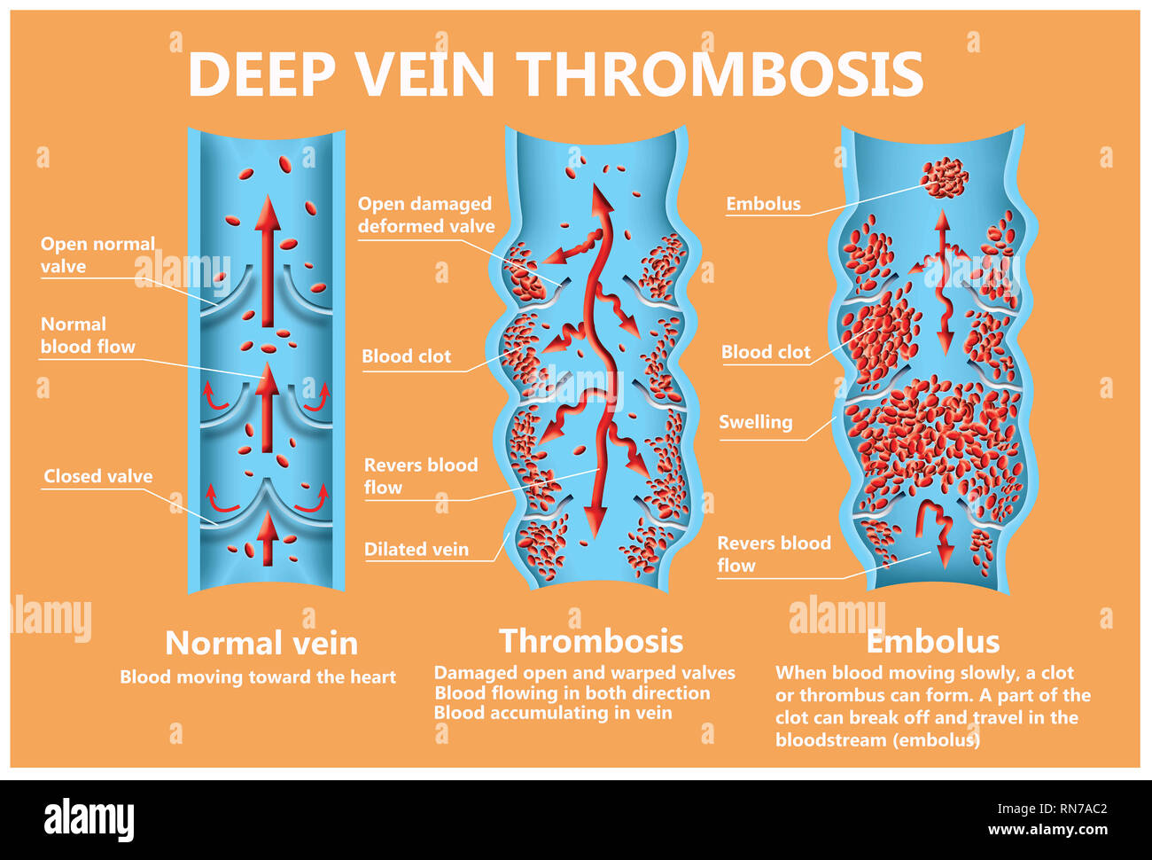 Tiefe Venenthrombose Stockfotos und -bilder Kaufen - Alamy