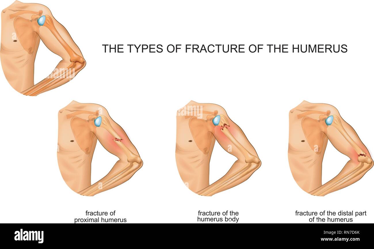 Vector Illustration des humerus Bruch, Traumatologie, Chirurgie Stock Vektor