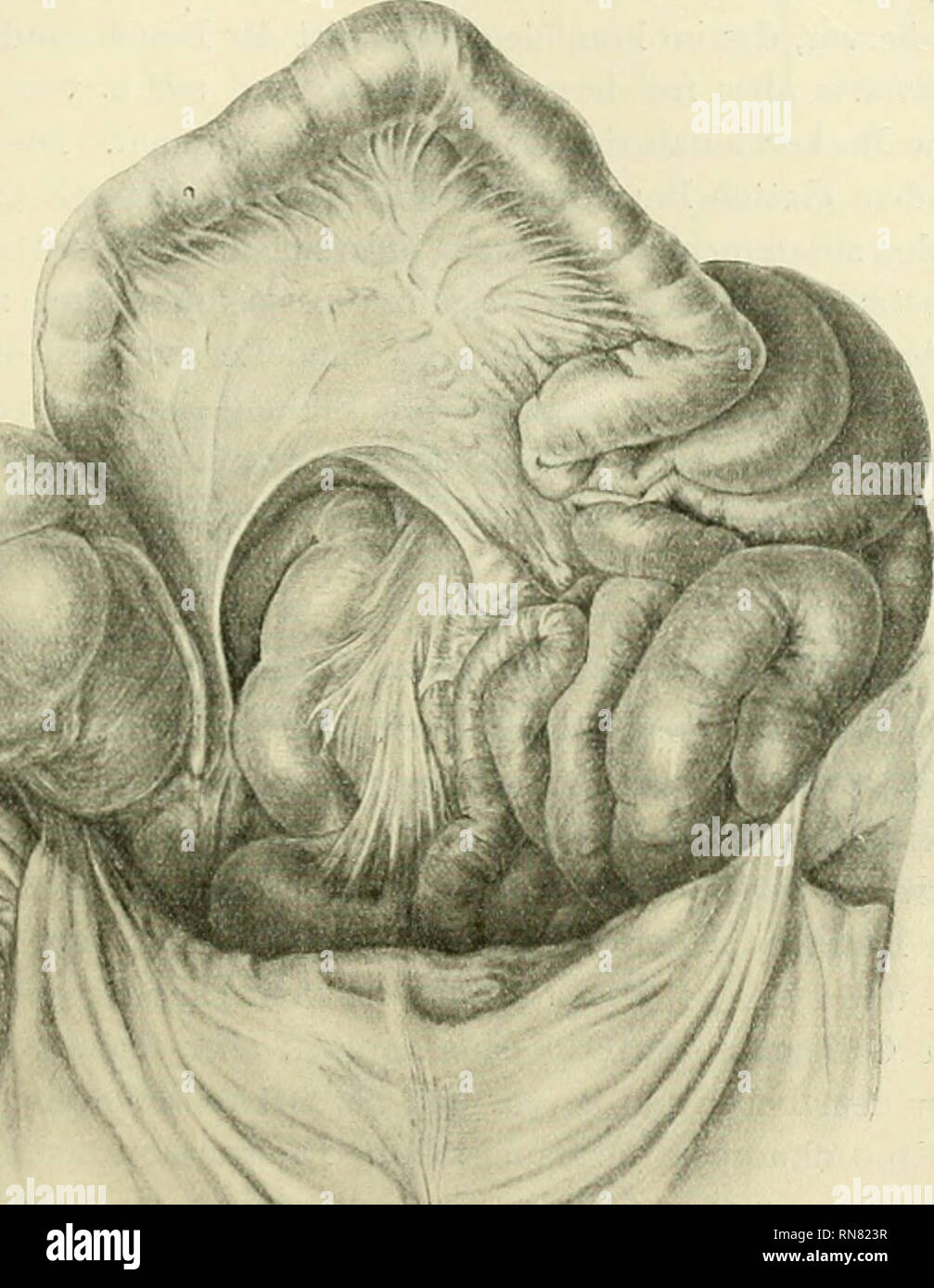 . Anatomische und entwicklungsgeschichtliche Festschrift herausgegeben. Situs. In der on the left side Lehrwerk der Bauchhöhle und im kleinen Becken lag Dünn - Darm, imd zwar der dickeren Wand / im kleinen Becken Jejunum. Colon descendens und Flexura sigmoidea nicht zutage traten. Rechts von der Wirbelsäule erschien eine glatte, von einigen Gefäßen durchzogene Peritonealdialyse - Fläche, imiralmit vom Caecum, Colon ascendens und der rechten Lehrwerk des Colon transversum. Das Caecum lag atypisch-statt in der Fossa iliaca v^^. Abb. I. Caecum / dsub, Ende des Ileum kraniahvärts gezogen. Einblick in die ATYP Stockfoto