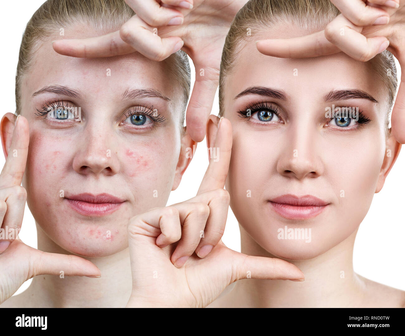 Junge Frau vor und nach der Hautpflege und Make-up. Stockfoto