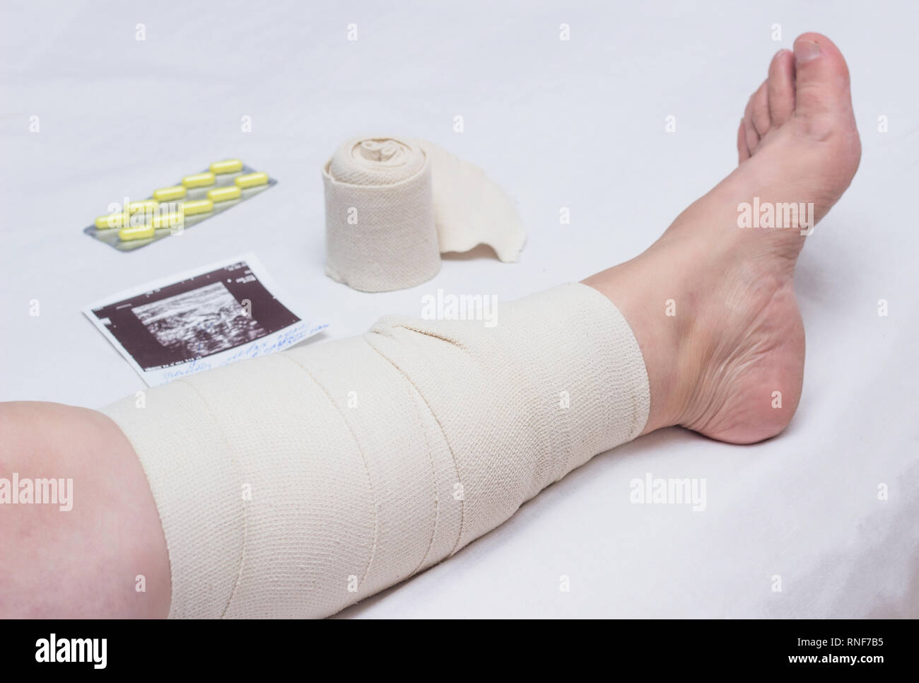 Kompressionstherapie bei Krampfadern in den Beinen einer Frau, bei der Behandlung von Krampfadern mit einer elastischen Bandage, Kompression stricken, beeinträchtigt die Durchblutung, Stockfoto