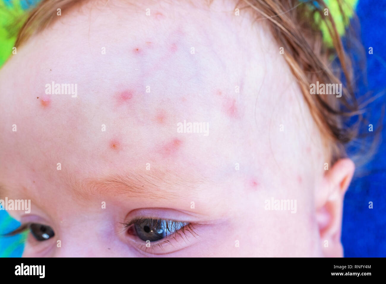Mückenstiche auf der Stirn ein kleines Baby im Sommer Stockfoto