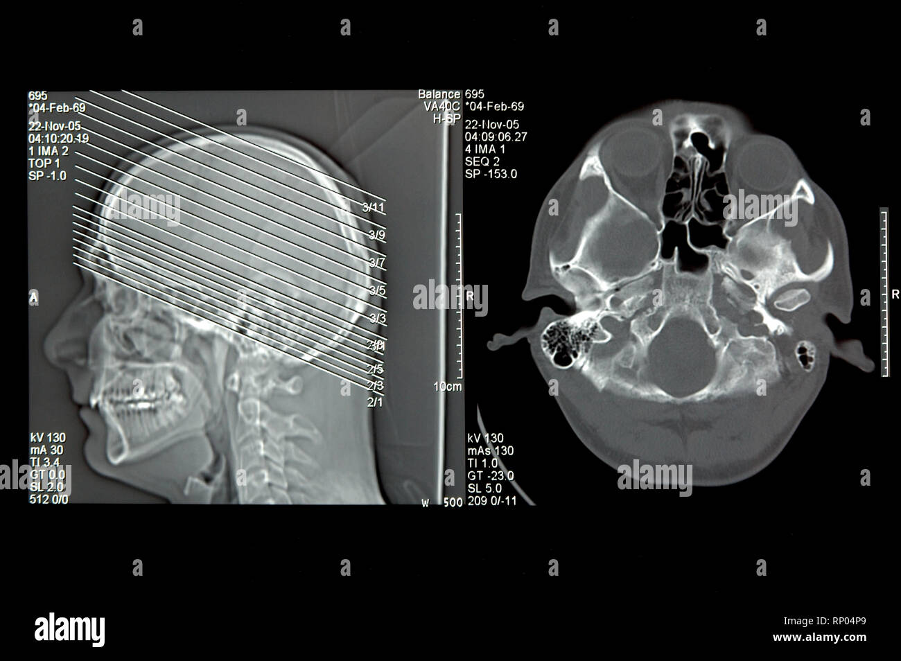 Kopf in der Computertomographie, CT-Bild Stockfoto