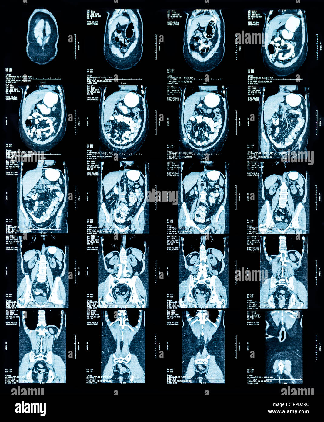 Die Magnetresonanztomographie (MRT) der Brust und Bauch Stockfoto