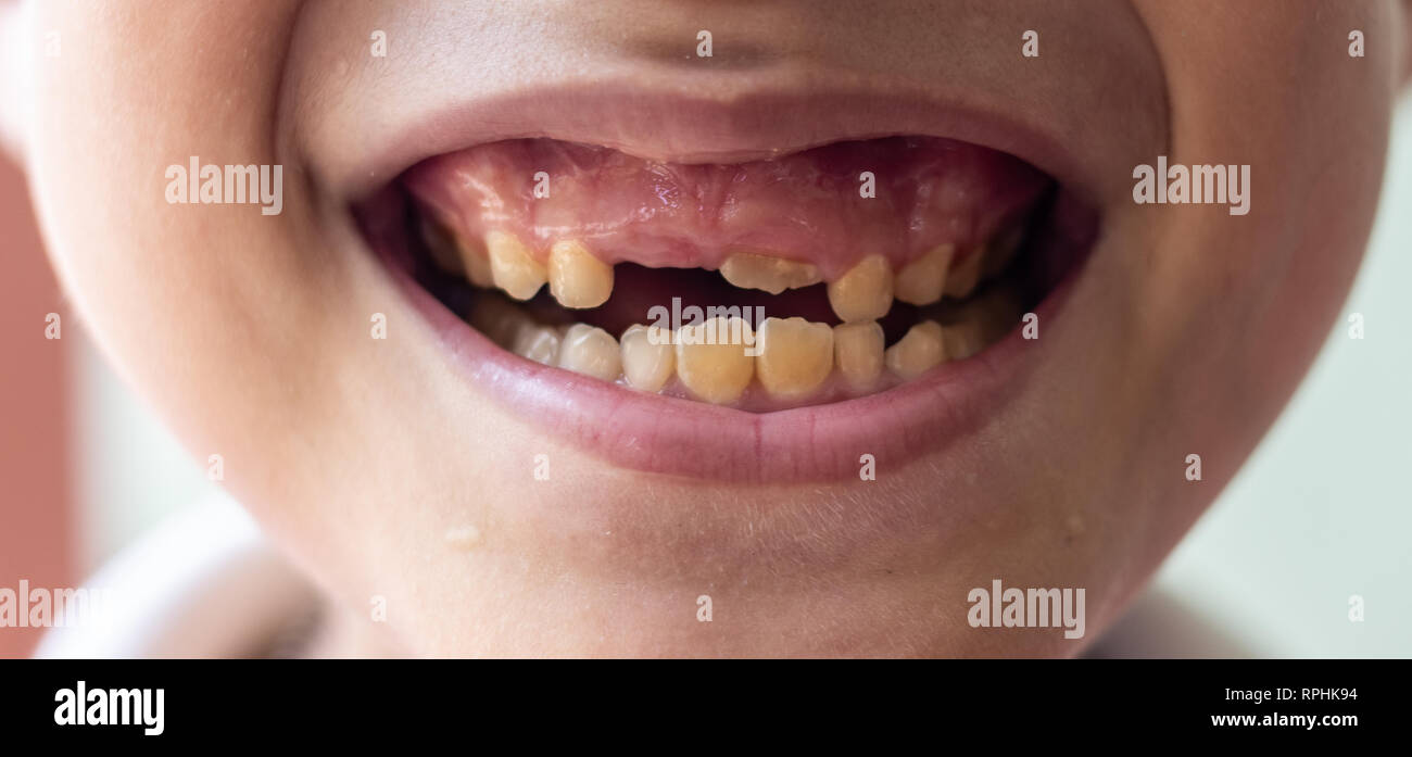 Faule Zähne Stockfotos und bilder Kaufen Alamy