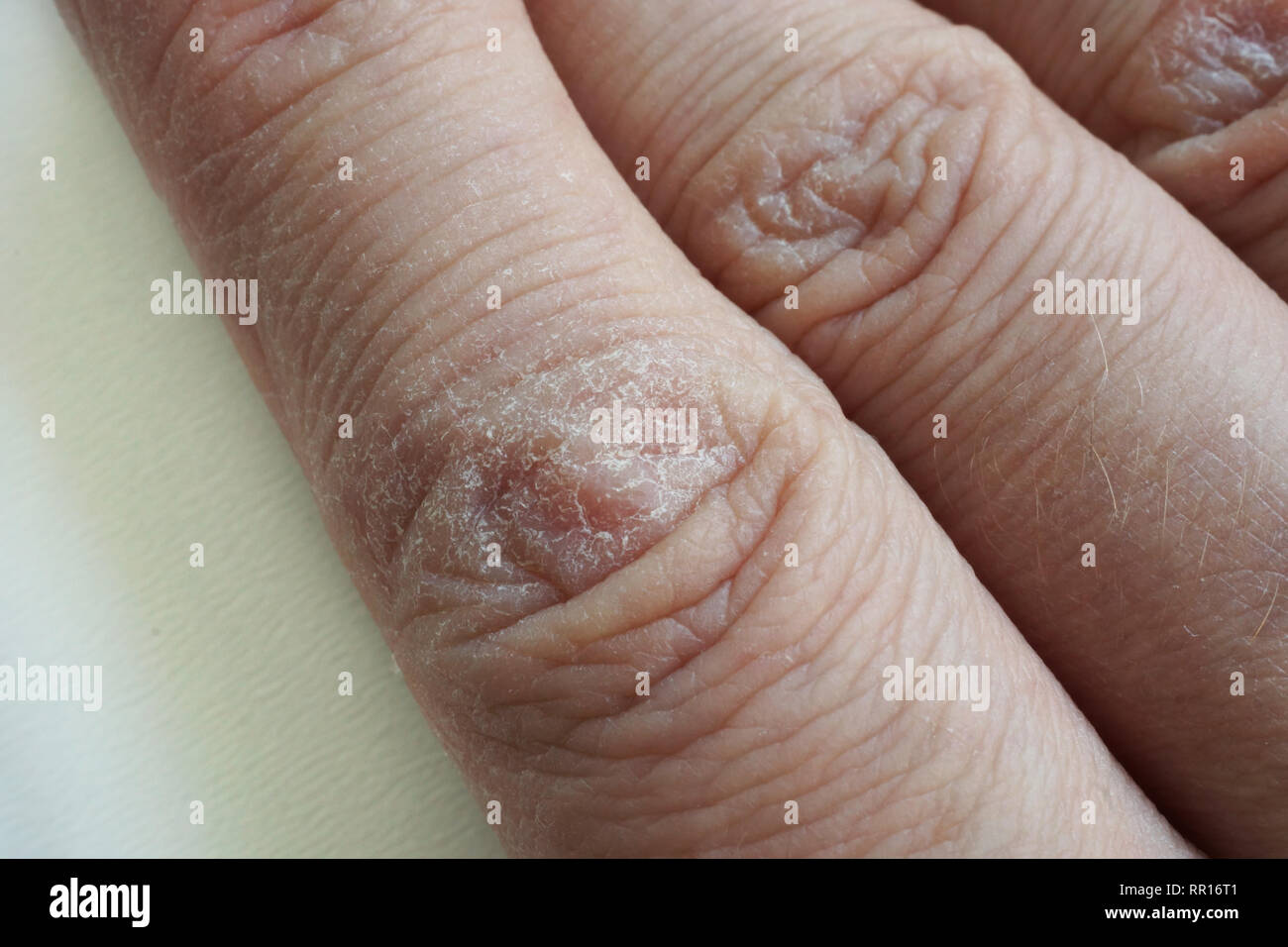 In Der Nahe Der Hande Mit Trockener Rissiger Haut Stockfotografie Alamy