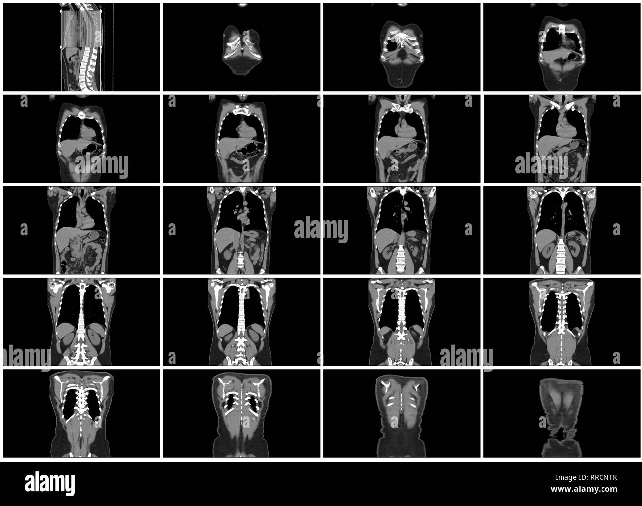 Ct-scan Schritt gesetzt von Körper koronalen Ansicht Stockfoto
