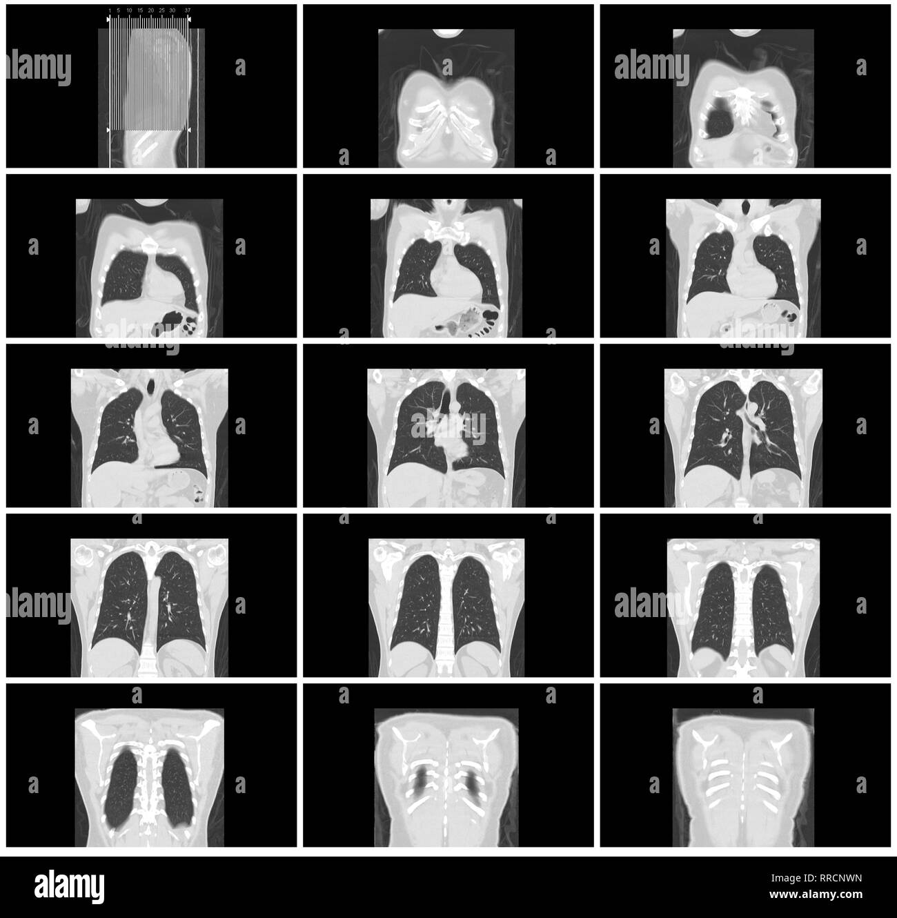 Ct-scan Schritt gesetzt von Körper Lunge koronalen Ansicht Stockfoto