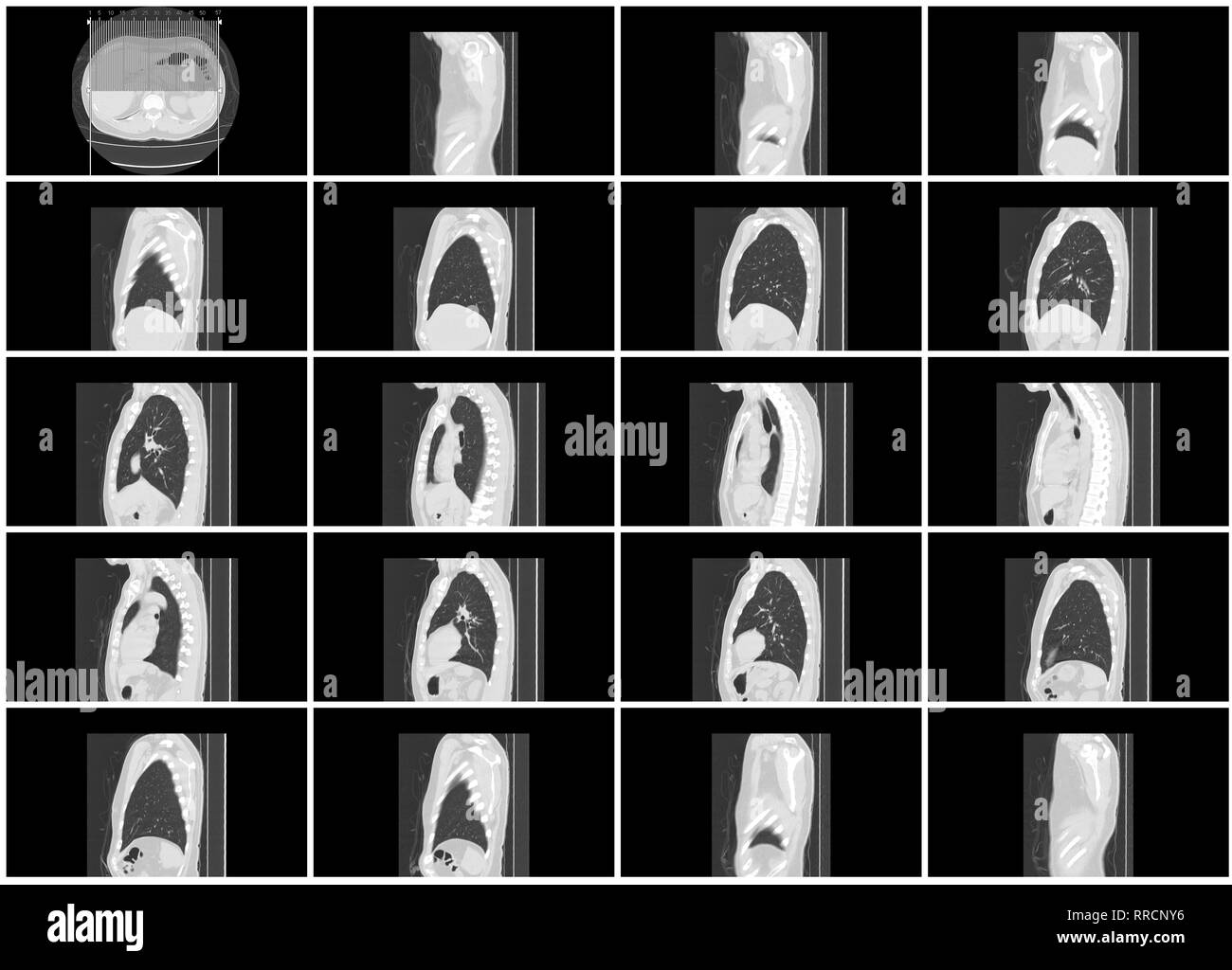 Ct-scan Schritt gesetzt von Körper Lunge sagittale Ansicht Stockfoto