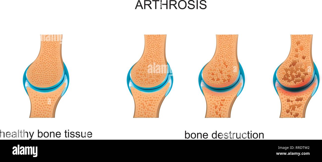 Vector Illustration von Arthrose. Zerstörung von Knochengewebe Stock Vektor