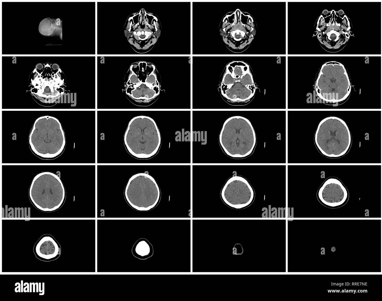 Ct-scan Schritt Satz oberer Gehirn Kopf axiale Ansicht von oben Stockfoto