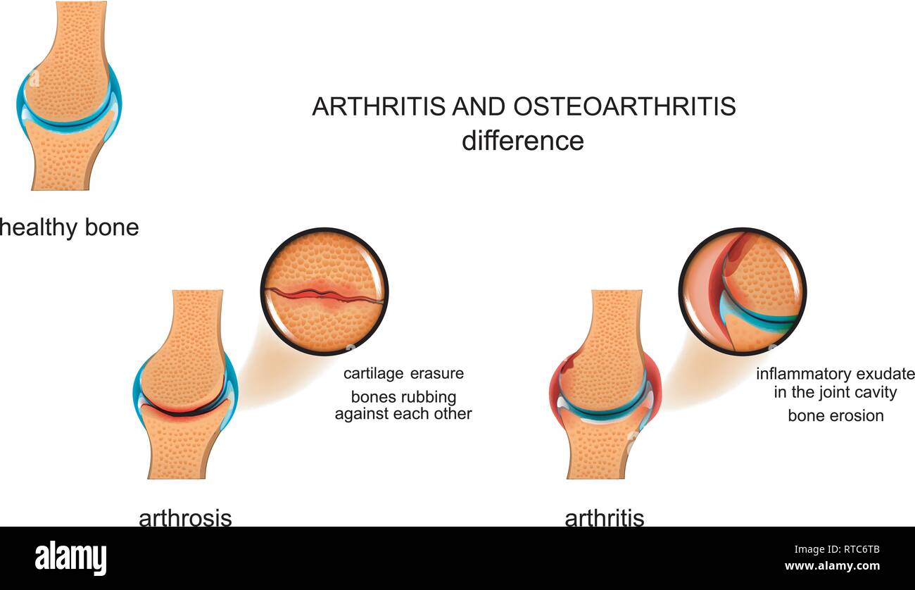 Unterschied Zwischen Arthritis Und Arthrose www.alamy.de