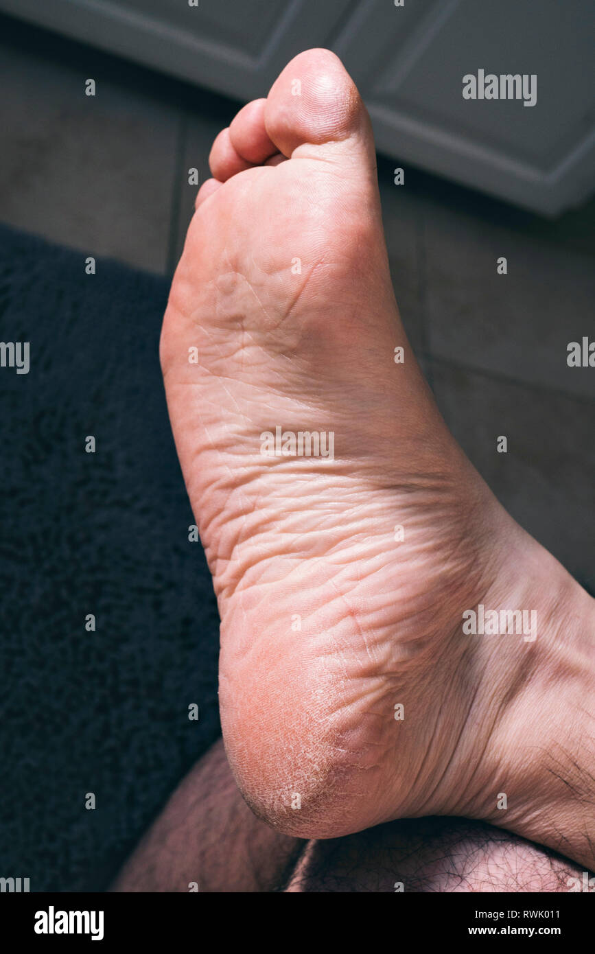 Ein männlicher Fuß mit trockener Haut und extrem trockene Ferse Stockfoto