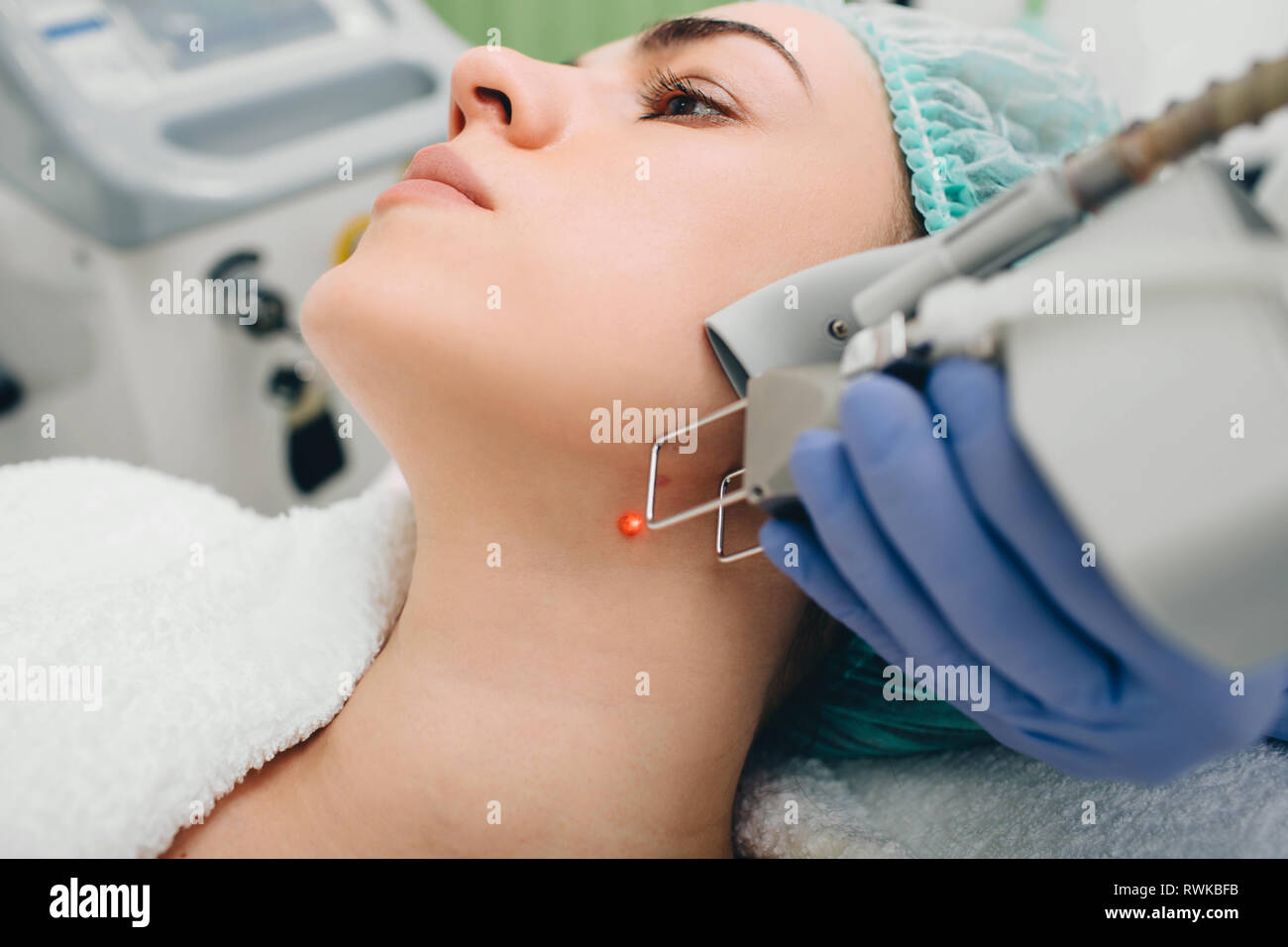 Muttermale Behandlung. Laser Mole Ausbau an der Klinik Stockfoto