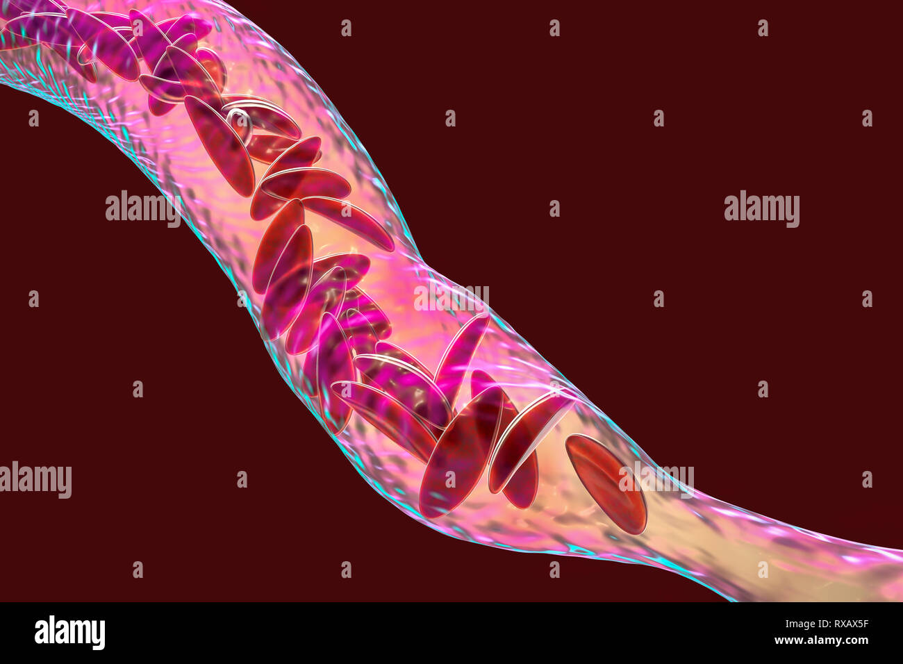 Blutgefäß in Sichelzellenanämie blockiert, Abbildung Stockfoto