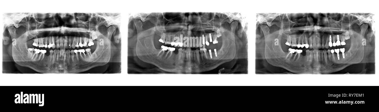 Panoramablick l X-Ray von menschlichen Zähnen. Prozess der implantologische Behandlung in verschiedenen Phasen Stockfoto