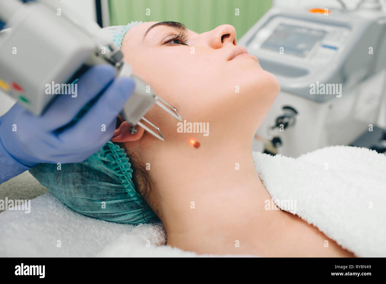 Patient, der eine Lasermole entfernt. Hautmolbehandlung. Stockfoto