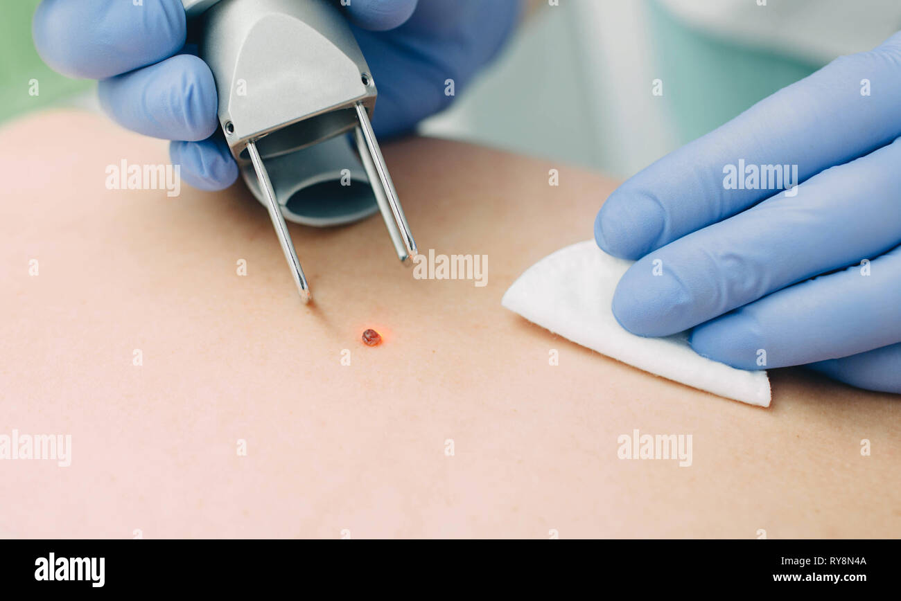Patient, der eine Lasermole entfernt. Hautmolbehandlung. Stockfoto