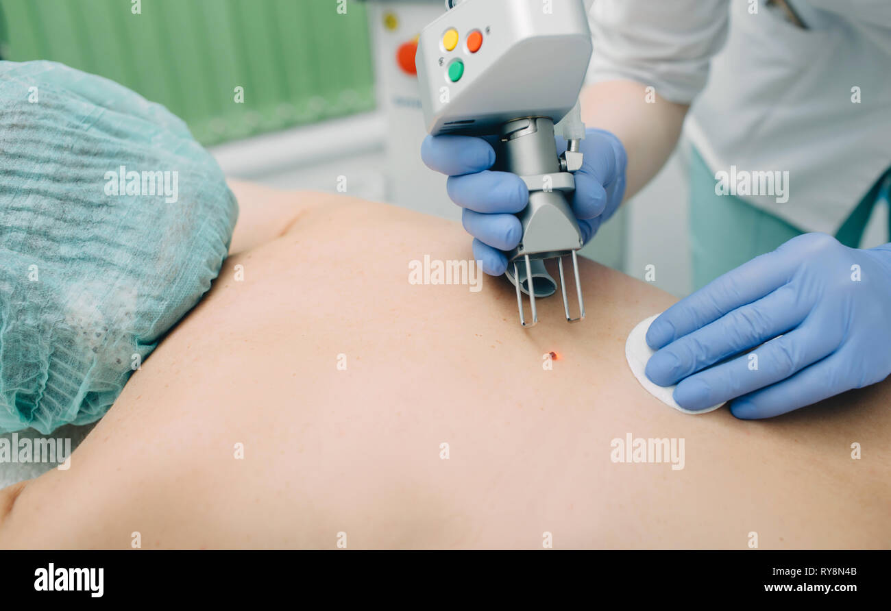 Patient, der eine Lasermole entfernt. Hautmolbehandlung. Stockfoto