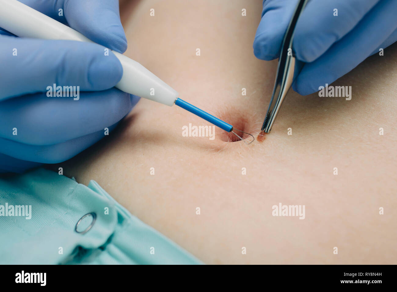 Verfahren entfernen Mole. Radio wave Elektrokoagulation Methode Stockfoto