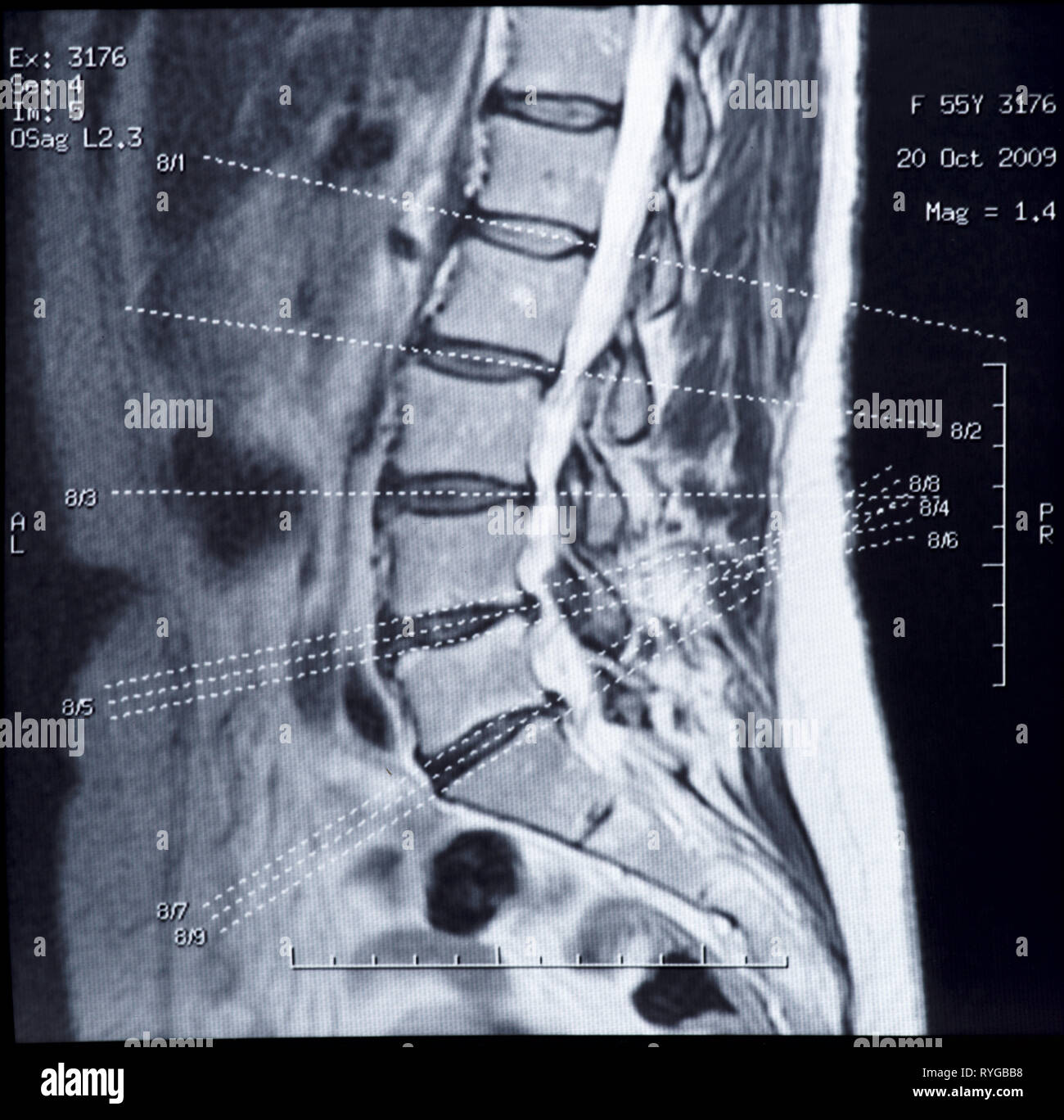 Mri Der Lendenwirbelsäule Stockfotos und bilder Kaufen Alamy