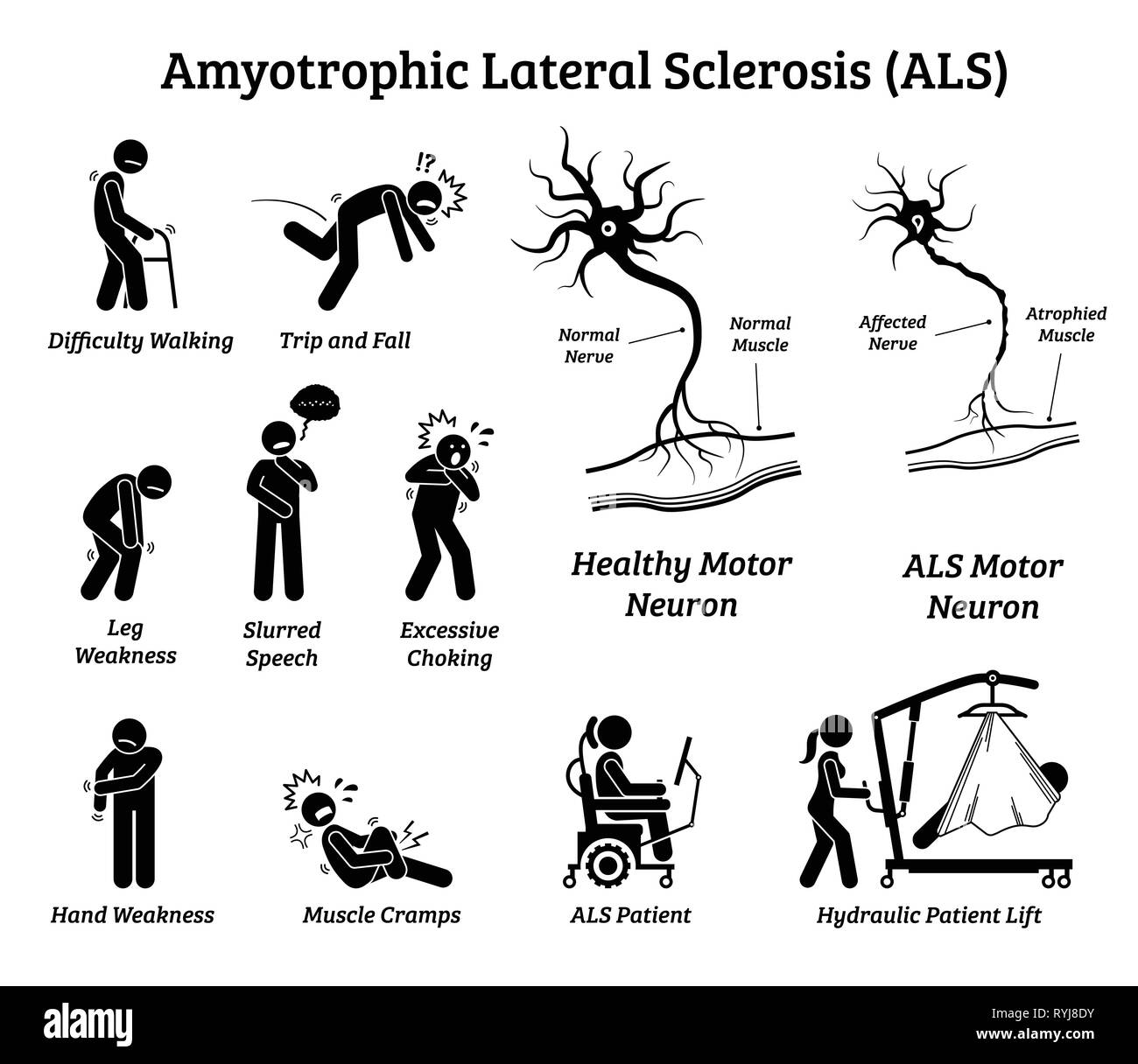 Amyotrophe Lateralsklerose als Krankheit Anzeichen und Symptome. Abbildungen zeigen Nervensystem oder neurologische Erkrankung bei ALS-Patienten. Stock Vektor