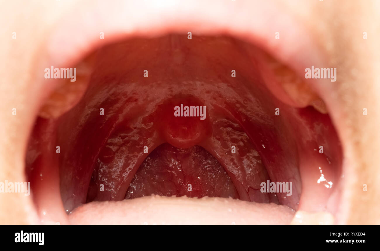 Ca tonsillen Tonsillectomy
