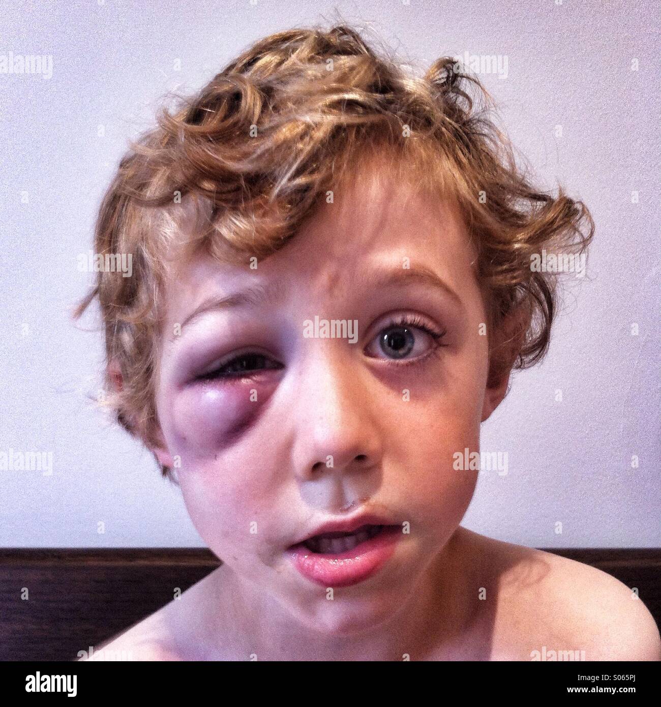 Geschwollenen blauen Auge auf einen fünf Jahre alten Jungen Stockfoto