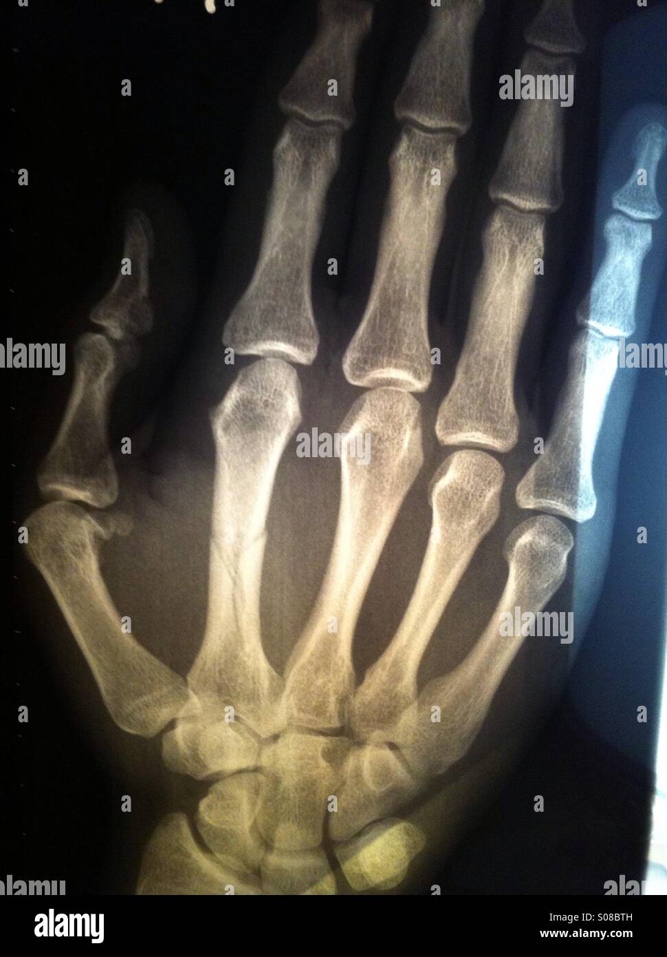 Röntgen-Hand Stockfoto