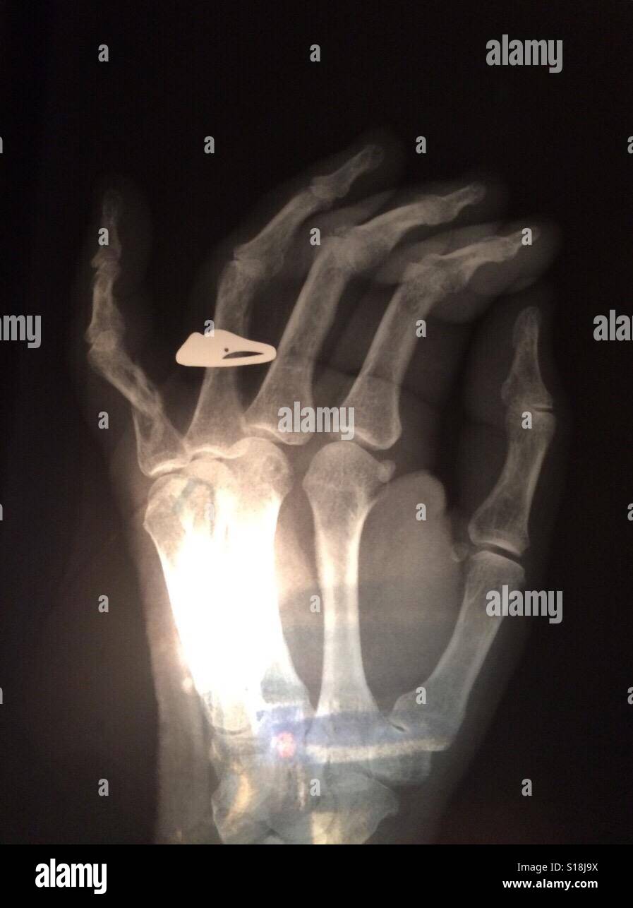 Gebrochener Finger Stockfotos und bilder Kaufen Alamy