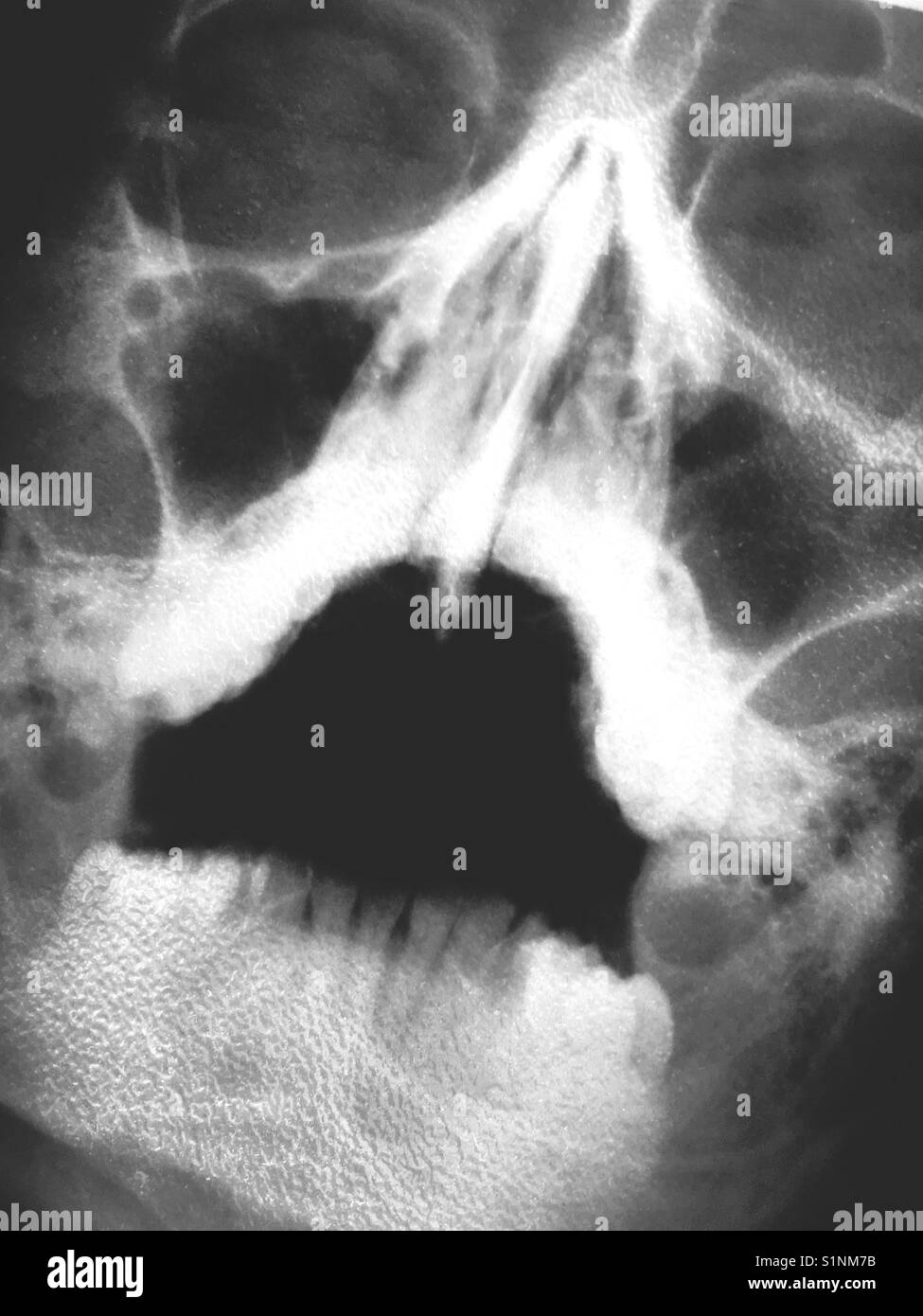 Ein x-ray von einem menschlichen Schädel Stockfoto