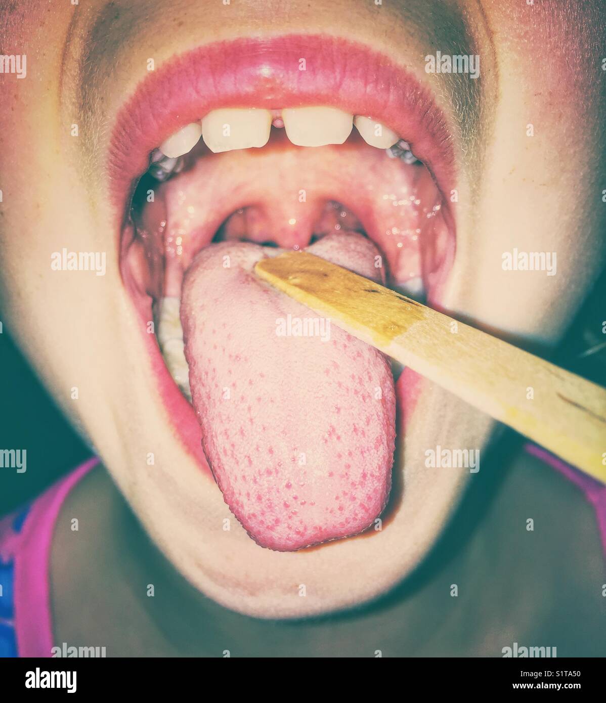 Blick auf die weit geöffneten Mund und Zungenspatel überprüft Kind Kehle für Virus Stockfoto