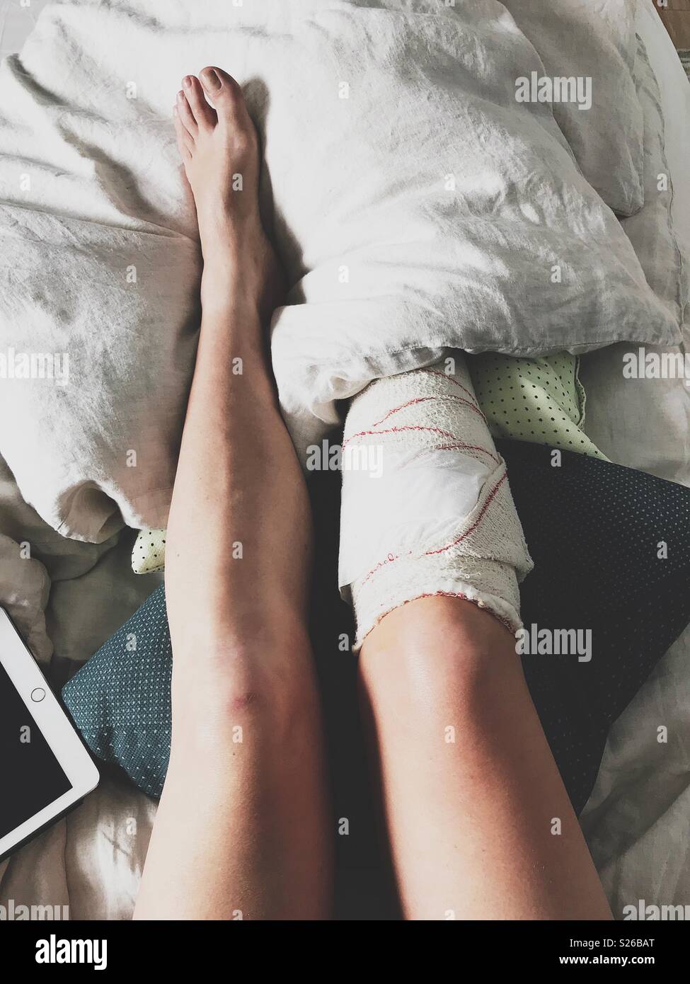 Wiederherstellung von einem gebrochenen Bein. Paar Beine von oben in ein Bett mit Kissen und eine Tablette. Stockfoto