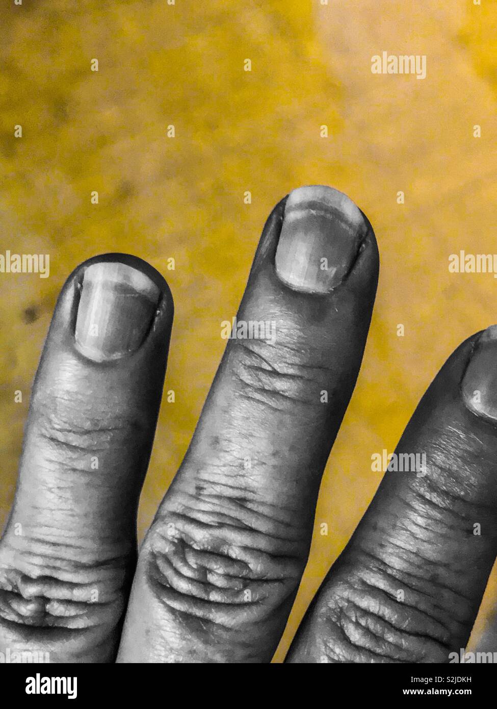 Gelbe Farbe pop Foto der Verletzung von Fingernagel durch eine weiße Markierung Stockfoto