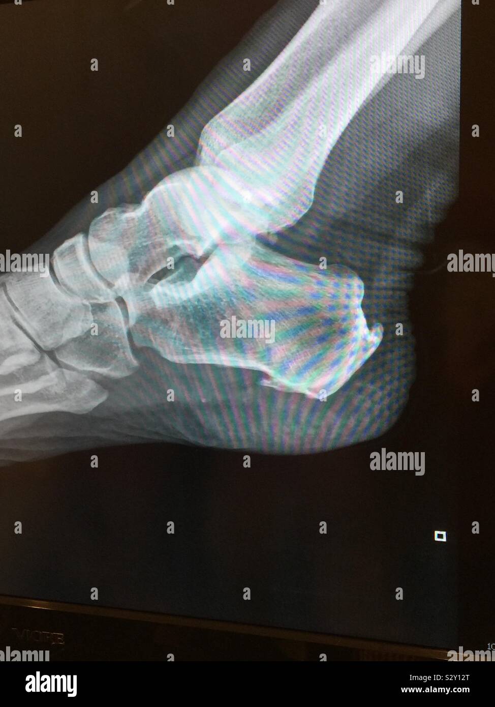 Fersensporn X-ray Stockfoto