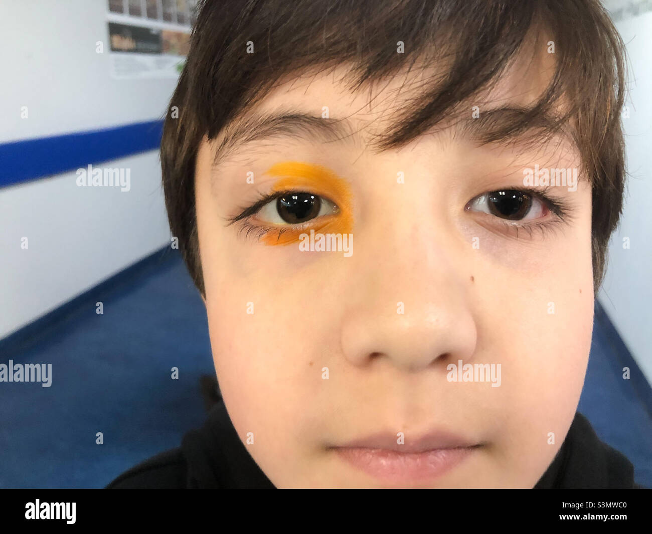 Ein Junge mit orangefarbenem Farbstoff im Auge, damit ein Arzt ordnungsgemäß nach Schäden an der Augenoberfläche suchen kann. - Smartphone-aufgenommenes Stockfoto