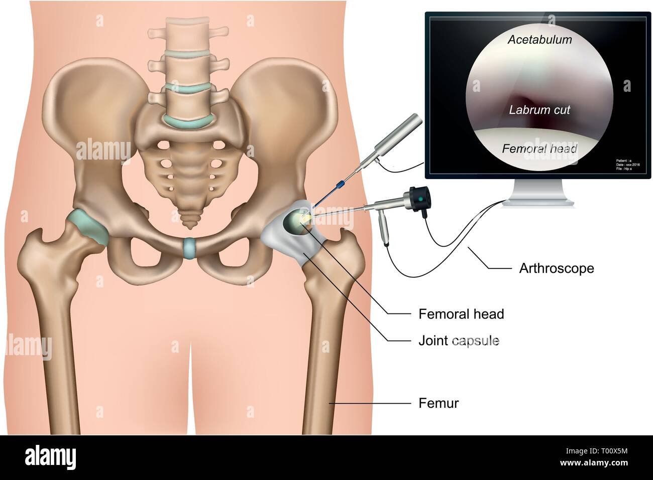 Hüftarthroskopie 3 d medical Vector Illustration auf weißem Hintergrund Stock Vektor