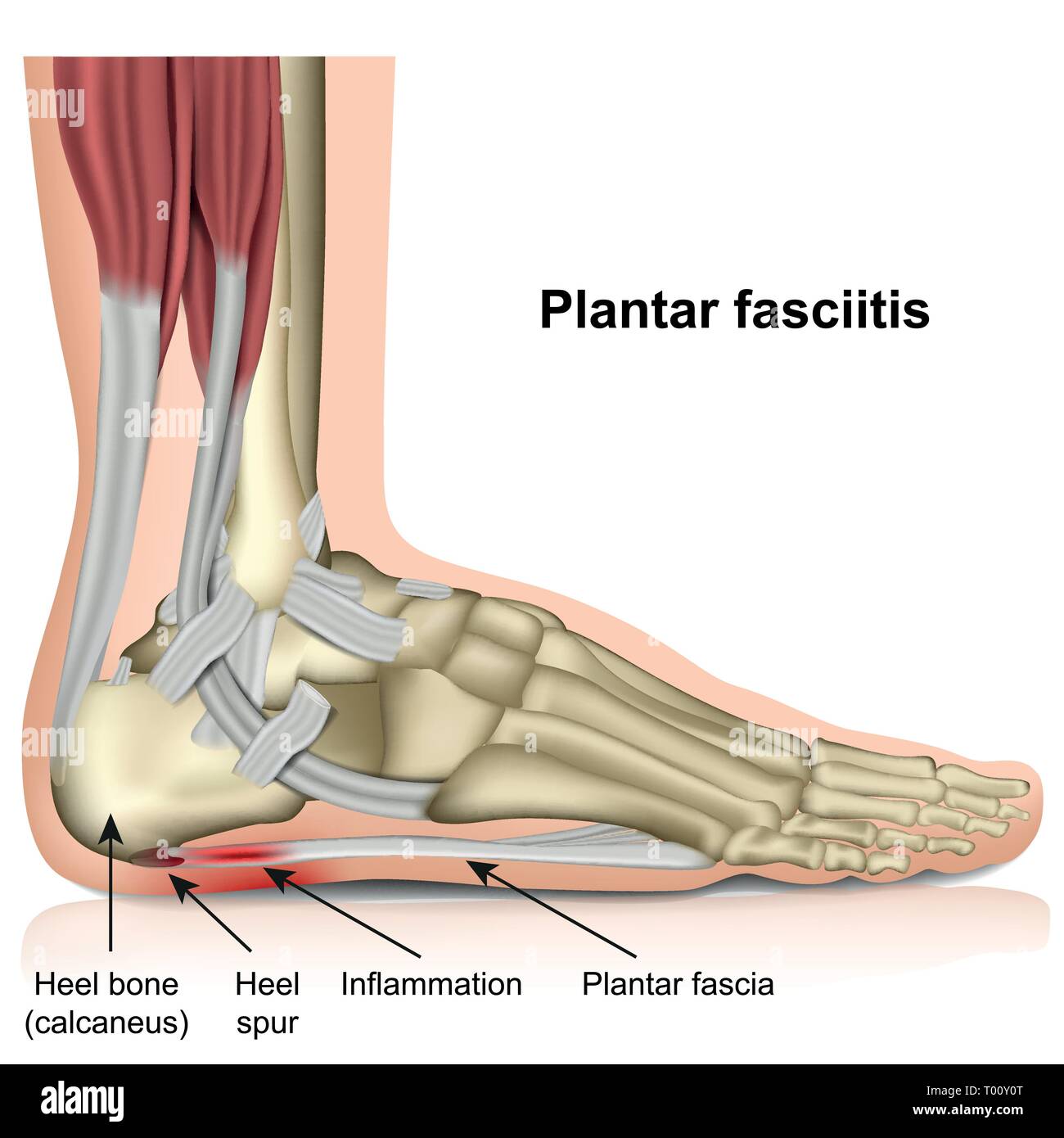 Plantar Fasciitis 3d medical Vector Illustration auf weißem Hintergrund Stock Vektor