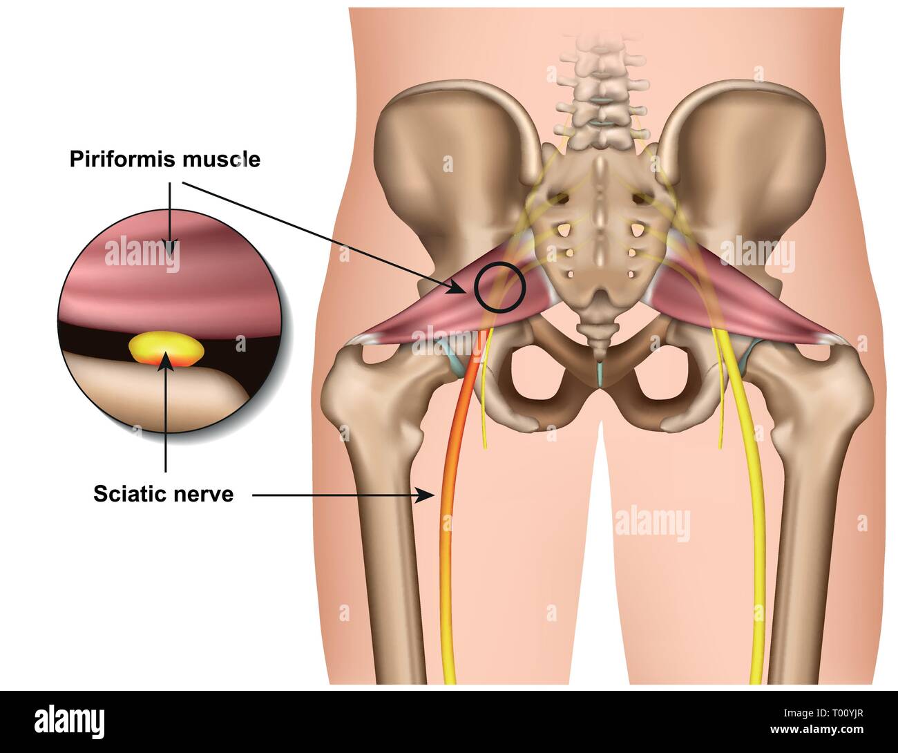 Piriformis-Syndrom 3 d medical Vector Illustration auf weißem Hintergrund Stock Vektor