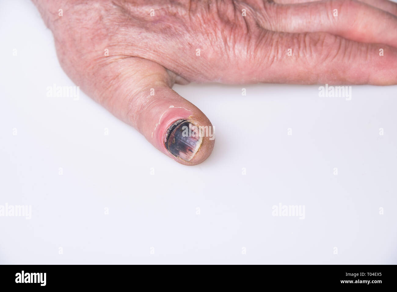 Linke Hand, schwarze Finger Nagel aus der Verletzung Stockfoto