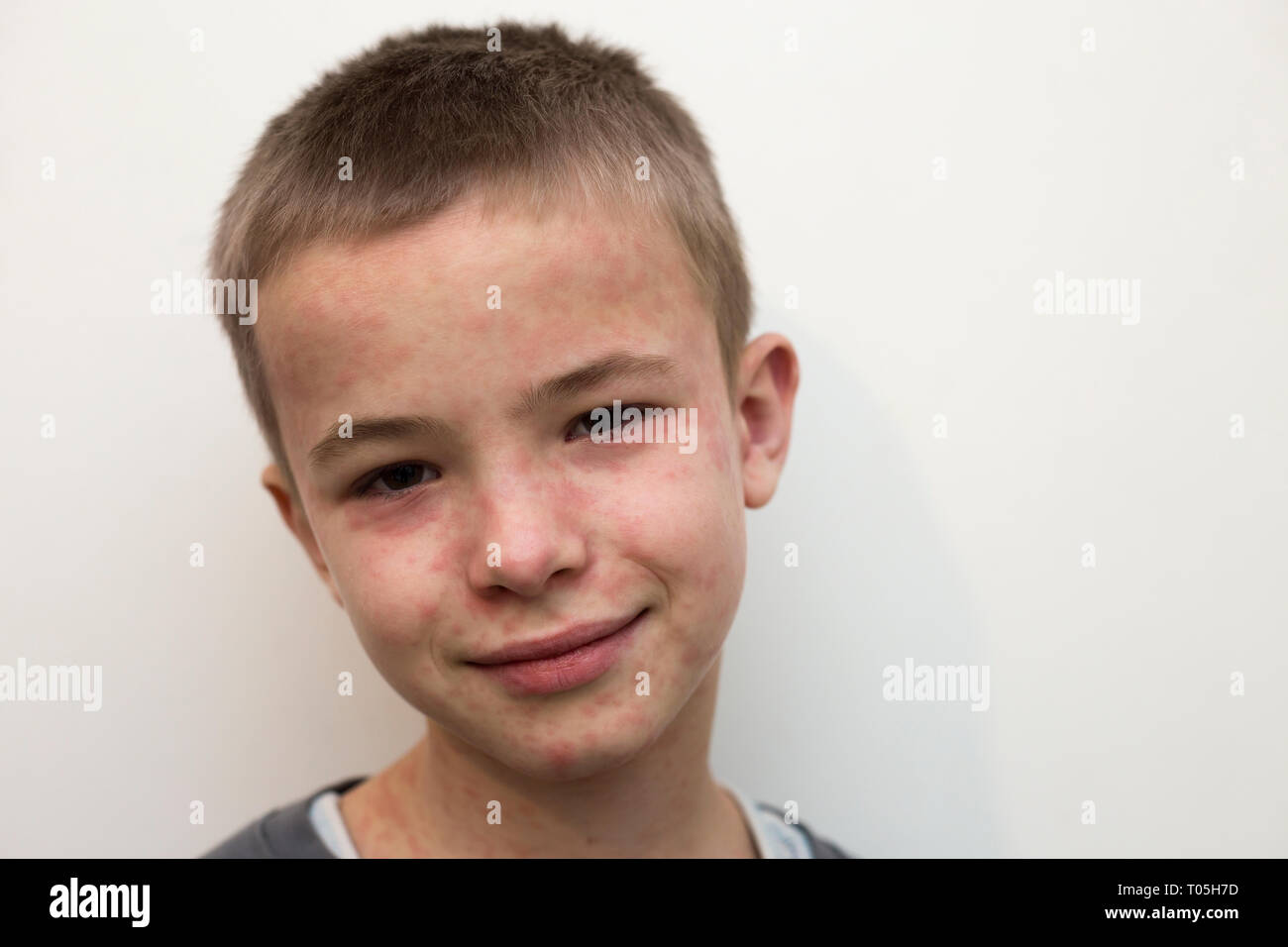 Portrait Von Kranken Lachelnde Junge Kind Leiden Von Masern Oder