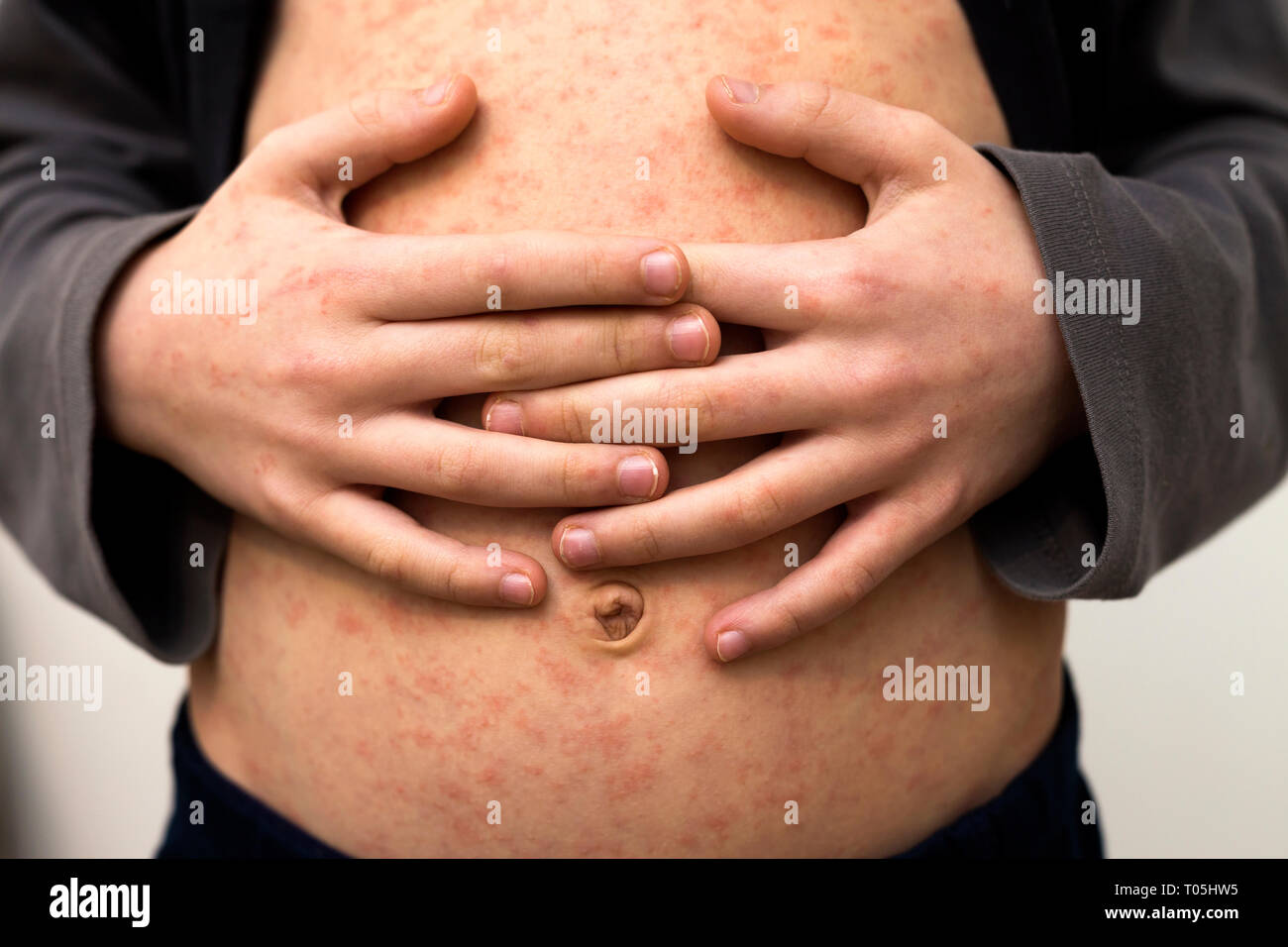 Kranken Kind Korper Bauch Mit Roten Rush Spots Von Masern Oder