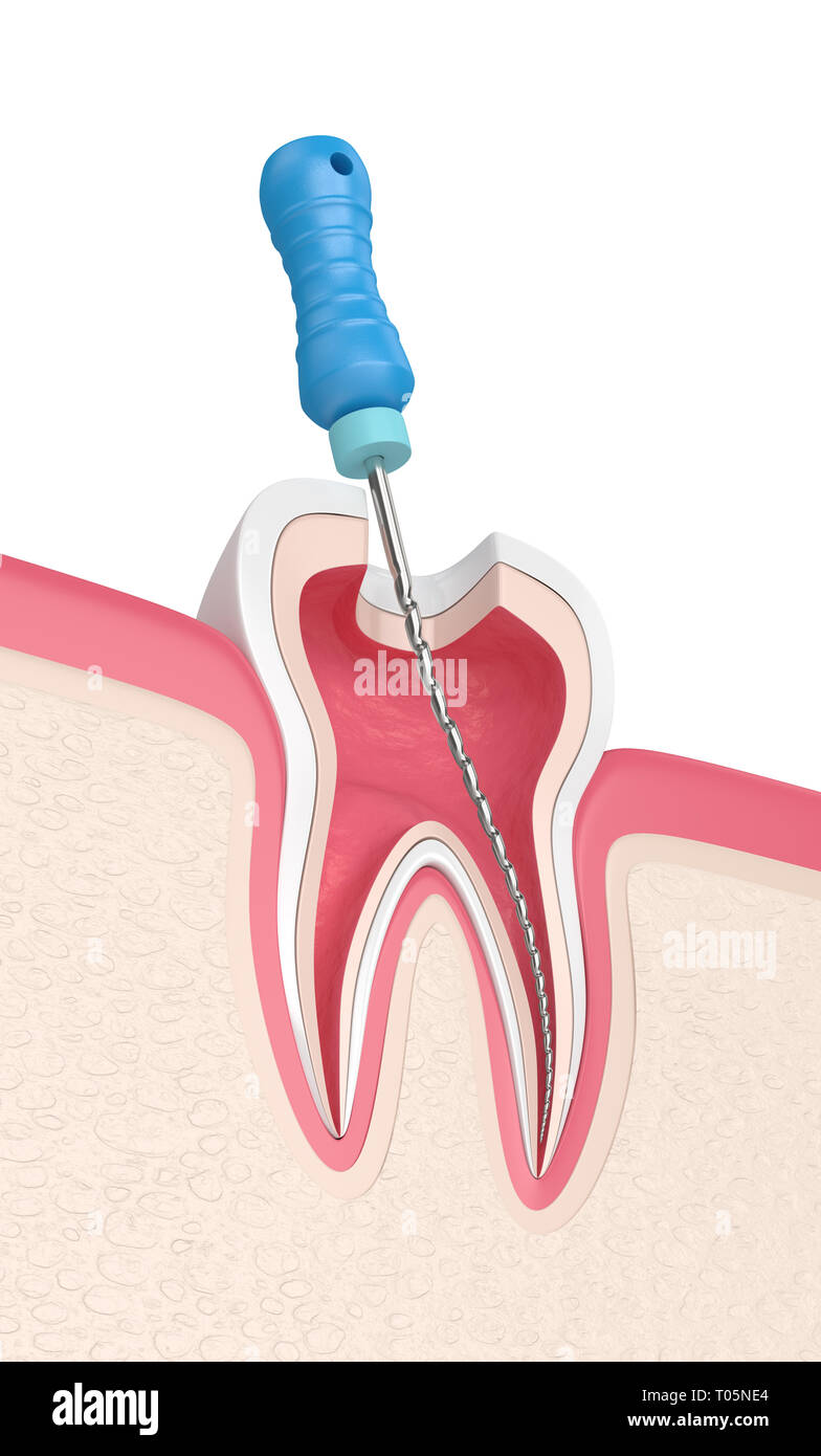 3D-Render von Zahn mit Endodontischen Datei im Zahnfleisch über weißen Hintergrund. Wurzelbehandlung Konzept. Stockfoto