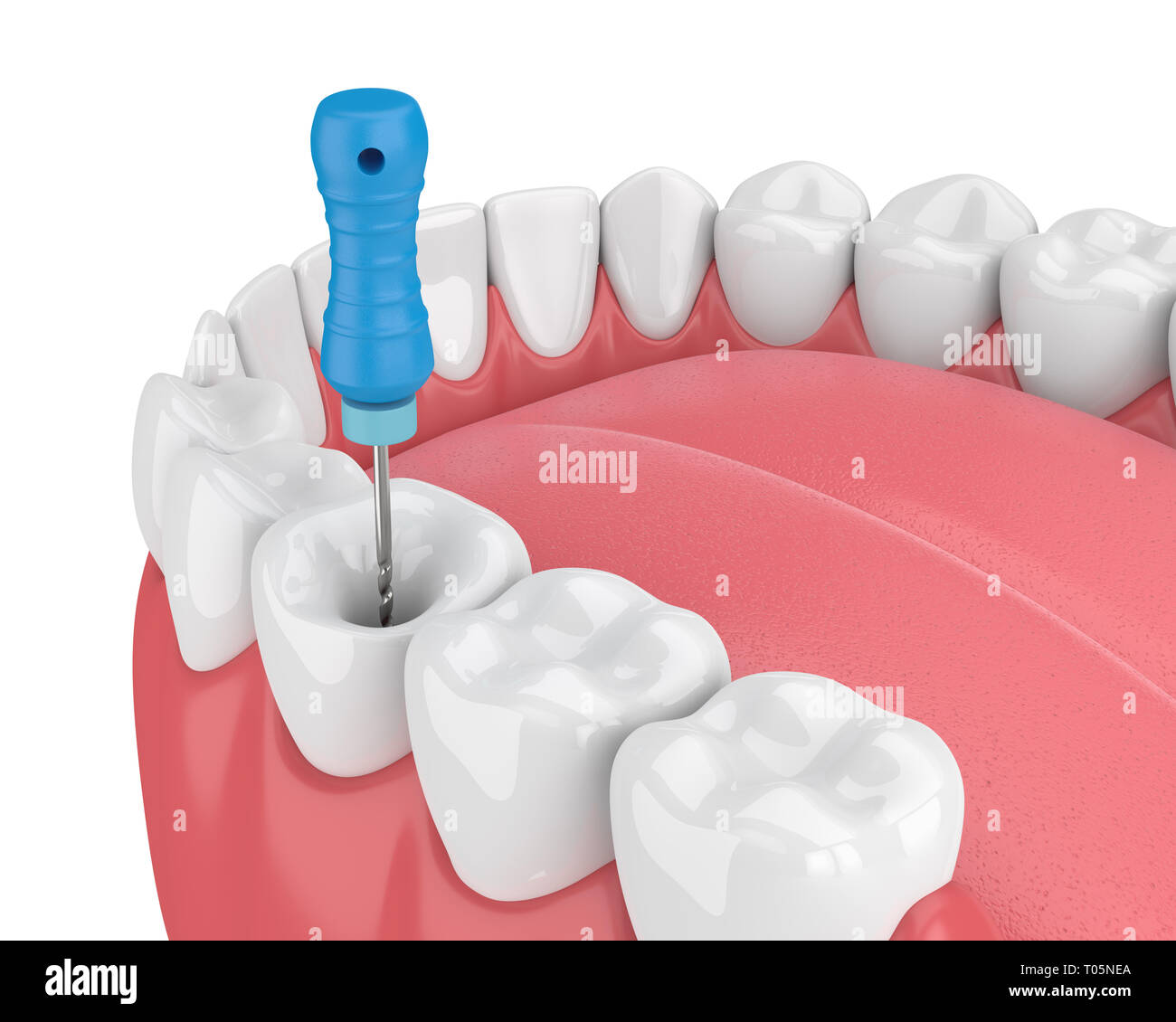 3D-Render von Zahn mit Endodontischen Datei im Kiefer auf weißen Hintergrund. Wurzelbehandlung Konzept. Stockfoto