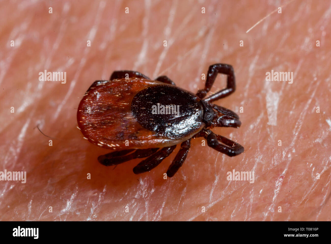 Castor bean Tick, die menschliche Haut, (Ixodes ricinus) Stockfoto